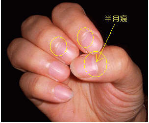 指甲上的半月痕你懂多少？指甲半月痕與健康吉兇