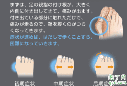 拇外翻矯正器有效果嗎 拇外翻矯正器一天帶多長時間3