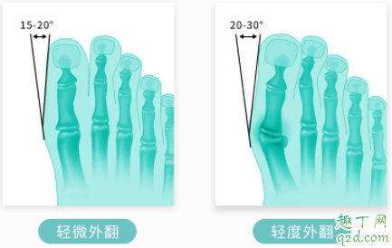 拇外翻矯正器有效果嗎 拇外翻矯正器一天帶多長時間4