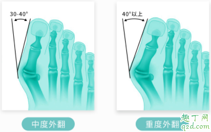 拇外翻矯正器有效果嗎 拇外翻矯正器一天帶多長時間5