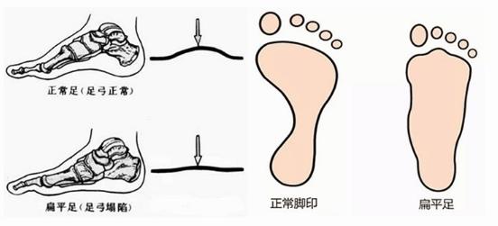 扁平足能跑步嗎？扁平足跑步有什么危害？